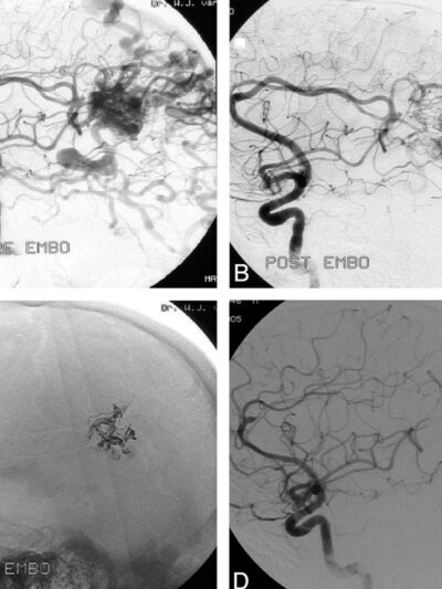 Avf File Cerebral AVM / AVF Treatment - Vista Interventional Care Center